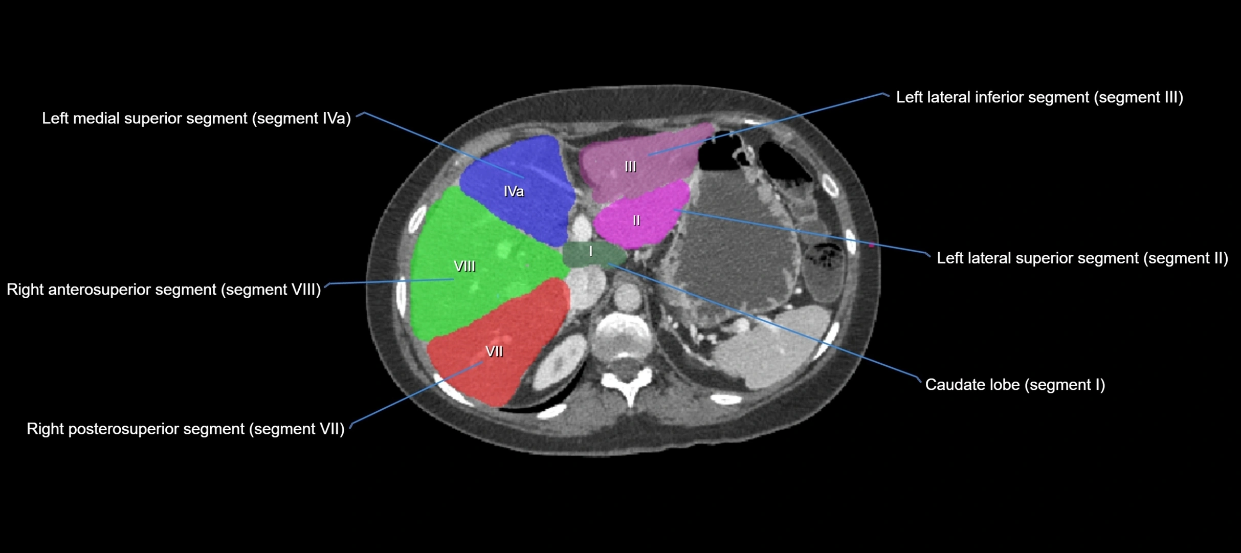 CT liver segments axial cross sectional anatomy labelled image-00050.webp